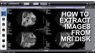 HOW TO EXTRACT IMAGES FROM A MRI DICOM DISK [upl. by Duffy]