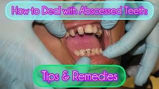 How to Deal with Abscessed Teeth Tips amp Remedies [upl. by Razec963]