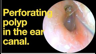 Perforating polyp in the ear canalear wax removal  ear cleaning  ASMR  relaxation  relax [upl. by Sacksen]