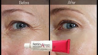 5Year RetinA Update  Before amp After for Wrinkles amp AntiAging [upl. by Von]