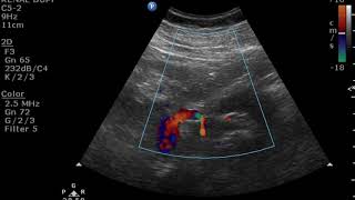 TMT RENAL DOPPLER PART V Indirect Signs of Renal artery stenosis [upl. by Ainival]