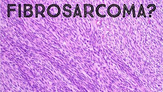 Fibrosarcoma amp Herringbone Pattern Explained in 5 Minutes pathology sarcoma dermpath [upl. by Pease337]