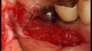 Soft tissue management using Dentium Collagen graft 2ProfJungChul Park [upl. by Asserac59]