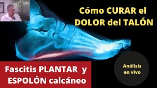 CÓMO CURAR EL DOLOR DEL TALÓN causado por FASCITIS PLANTAR y ESPOLÓN CALCÁNEO [upl. by Zildjian]