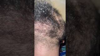 Beard hair removal removingingrown hairissue satisfying ingrownhairremoval hair ingrown [upl. by Ahsa]