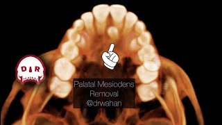 Palatal Mesiodens Extra Tooth Removal drwahan [upl. by Smitty]