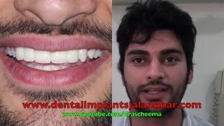 Front Upper Teeth Gap Dental implants jalandhar patiala Punjab India [upl. by Bogart691]