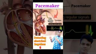 Pacemaker heart pacemaker shorts medical [upl. by Shaw]