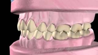 What is Orthodontics [upl. by Reisman812]