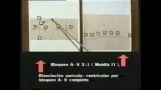 31 Semiología Médica de Lasala El examen físico del aparato cardiovascular 33 [upl. by Asecnarf]