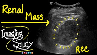 Renal Cell Carcinoma  RCC  Ultrasound  Doppler  Case 41 [upl. by Marijo210]