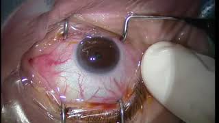 Lucentis Intravitreal Injection Technique for maculopathy [upl. by Jobe303]