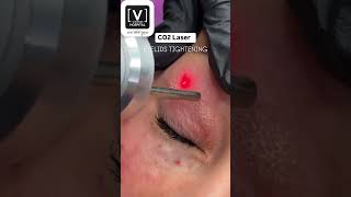 Co2 Laser Treatment  Eyelids Treatment  Best Derma Hospital in Kanpur [upl. by Sulienroc]