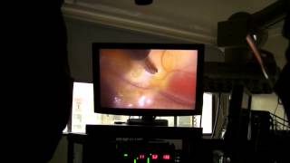 Cardiac denervation by uniport video assisted thoracoscopy [upl. by Ihel]