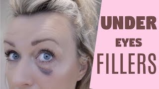 EYE TROUGH FILLERS  MONDAY CHAT [upl. by Malcolm286]