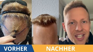 Der Verlauf der Haartransplantation  Alle Vorher Nachher Bilder [upl. by Grieve]