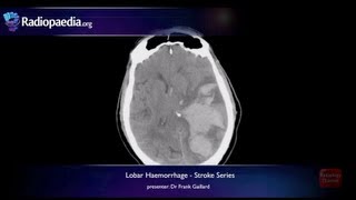 Stroke Lobar haemorrhage  radiology video tutorial MRI CT [upl. by Rollin]