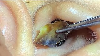 耳垢の山 MASSIVE Earwax Unearthed a pile of earwigs Big earwax earwax earwaxcleaner earwaxremoval [upl. by Fayina]