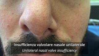 Insufficienza della valvola nasale dilatatore nasale vs cerotto nasale [upl. by Leander]