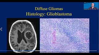 Understanding Neuropathology UCLA Brain Tumor Virtual Conference [upl. by Hackathorn705]