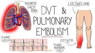 Deep Vein Thrombosis DVT amp Pulmonary Embolism Explained [upl. by Touber]