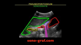 Sonographie  Pneumoperitoneum [upl. by Ahsytal]