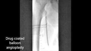 Jetstream and drug coated balloon for popliteal instent restenosis [upl. by Hallerson]