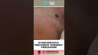 Gynecomastia Treatment Surgery Procedure  Male Breast Surgery in Delhi  Dr PK Talwar [upl. by Ela]