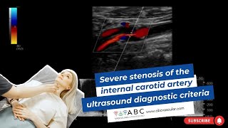 Severe stenosis of the internal carotid artery ultrasound diagnostic criteria [upl. by Denna]