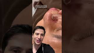 This thing SUCKS dermreacts pimplepopping [upl. by Treve]