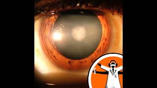 Eye drops to treat cataracts [upl. by Rawlinson233]