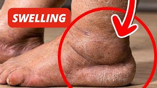 1 Vitamin to Eliminate Edema [upl. by Awhsoj]