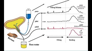 URODYNAMIC STUDY IN CHILDRENBASICS TO ADVANCED [upl. by Baillieu]