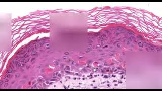 Erythema Multiforme Dermatopathology Easy learning [upl. by Melac672]