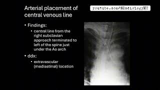 Cases 131 Arterial placement ofcentral venous line [upl. by Jany]