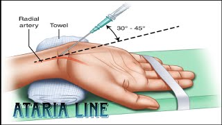 ••Arterial line insertion ••Arterial line placement ••Arterial cannula💉 [upl. by Brenna643]