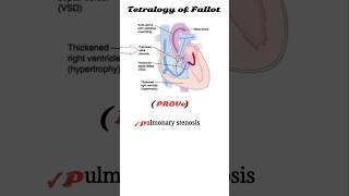 tetralogy of fallot mnemonic  TOF [upl. by Ettenrahc]