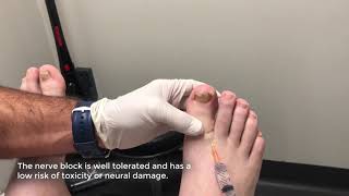 Local Anaesthetic for an Ingrown Toenail [upl. by Wise861]