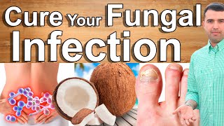 Eliminate Fungal Infections With These Home Remedies  Say Goodbye Digestive Skin Fungal Infections [upl. by Amsirac145]