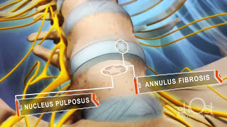 Herniated DISC Medical Animation  Ghost Medical Animation amp Surgical VR [upl. by Leviralc696]