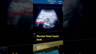 Fetal Heart Beat fetal bradycardia fetalultrasound fetal soundytshorts babyheartbeat [upl. by Krause]