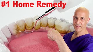 1 Home Remedy to Remove Dental Plaque amp Tarter to Prevent Cavities  Dr Mandell [upl. by Cesare]