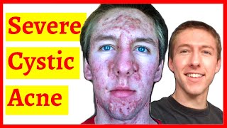 Cystic Acne Skin Clearing Transformation  10 Month Timelapse [upl. by Ecadnak]