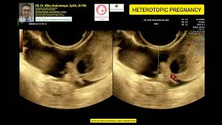 Heterotopic Pregnancy [upl. by Yenitirb]