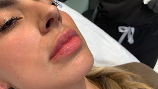 GET THOSE JUICY RUSSIAN LIPS 👄WITH NO DOWNTIME FILLER INJECTIONS  Hollywood CA  Dr Jason Emer [upl. by Vahe]