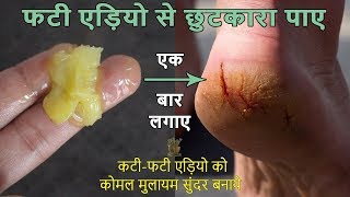 फटी एड़ियो से छुटकारा पाने का अचूक उपायCracked Heels Home Remedy  Cracked Heels Treatment [upl. by Nirro858]