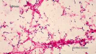 Bacterial Meningitis [upl. by Pergrim126]