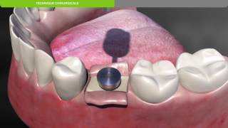 Biotech Dental Protocole chirurgical de pose dun implant dentaire KONTACT souscrestal [upl. by Ystap]