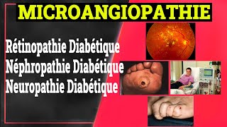 Complications Chroniques du Diabète Microangiopathie Diabétique  Endocrinologie Medicale [upl. by Niela]