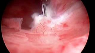 Hysteroscopic Morcellation of Myoma [upl. by Aicilef]